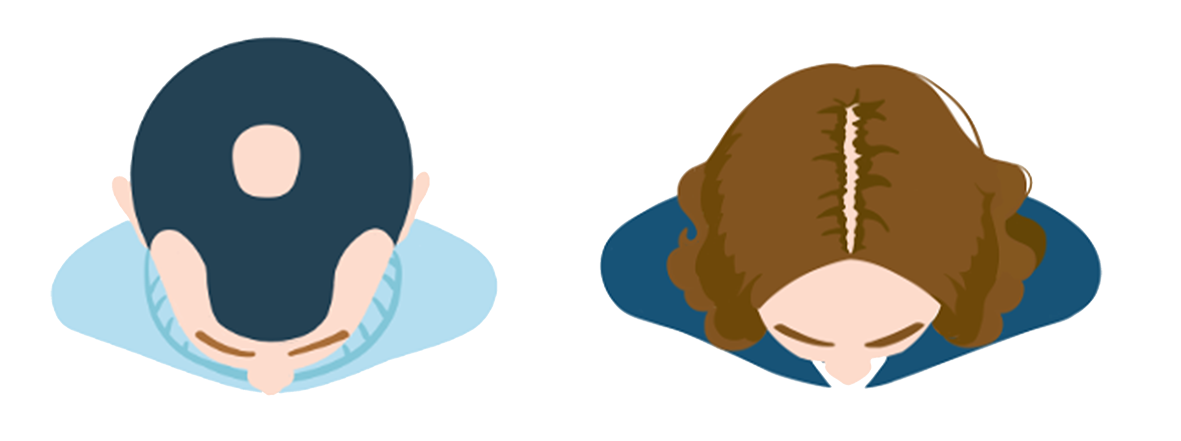 表情包2-男性和女性雄激素性脱发.png 表情包2-男性和女性雄激素性脱发.png